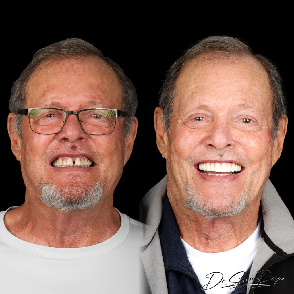 Before and after full mouth dental implants in Denver, CO by Dr. Soren Paape at Smile Now Denver Dentures and Implants