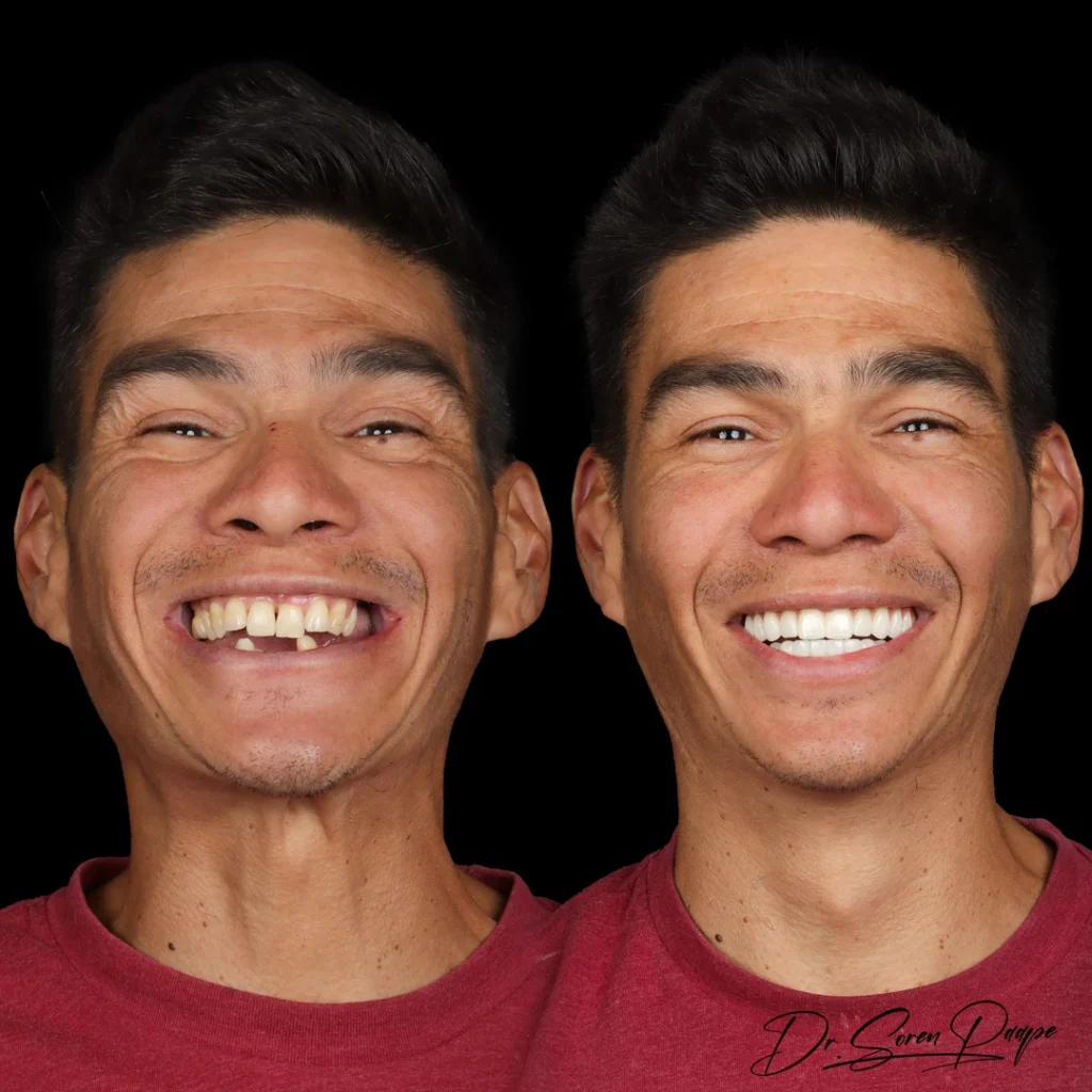 Before and after full mouth dental implants in Denver, CO by Dr. Soren Paape at Smile Now Denver Dentures and Implants