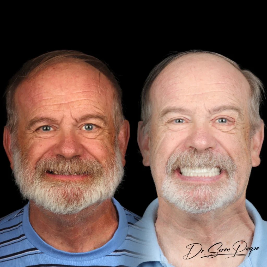 Before and after full mouth dental implants in Denver, CO by Dr. Soren Paape at Smile Now Denver Dentures and Implants