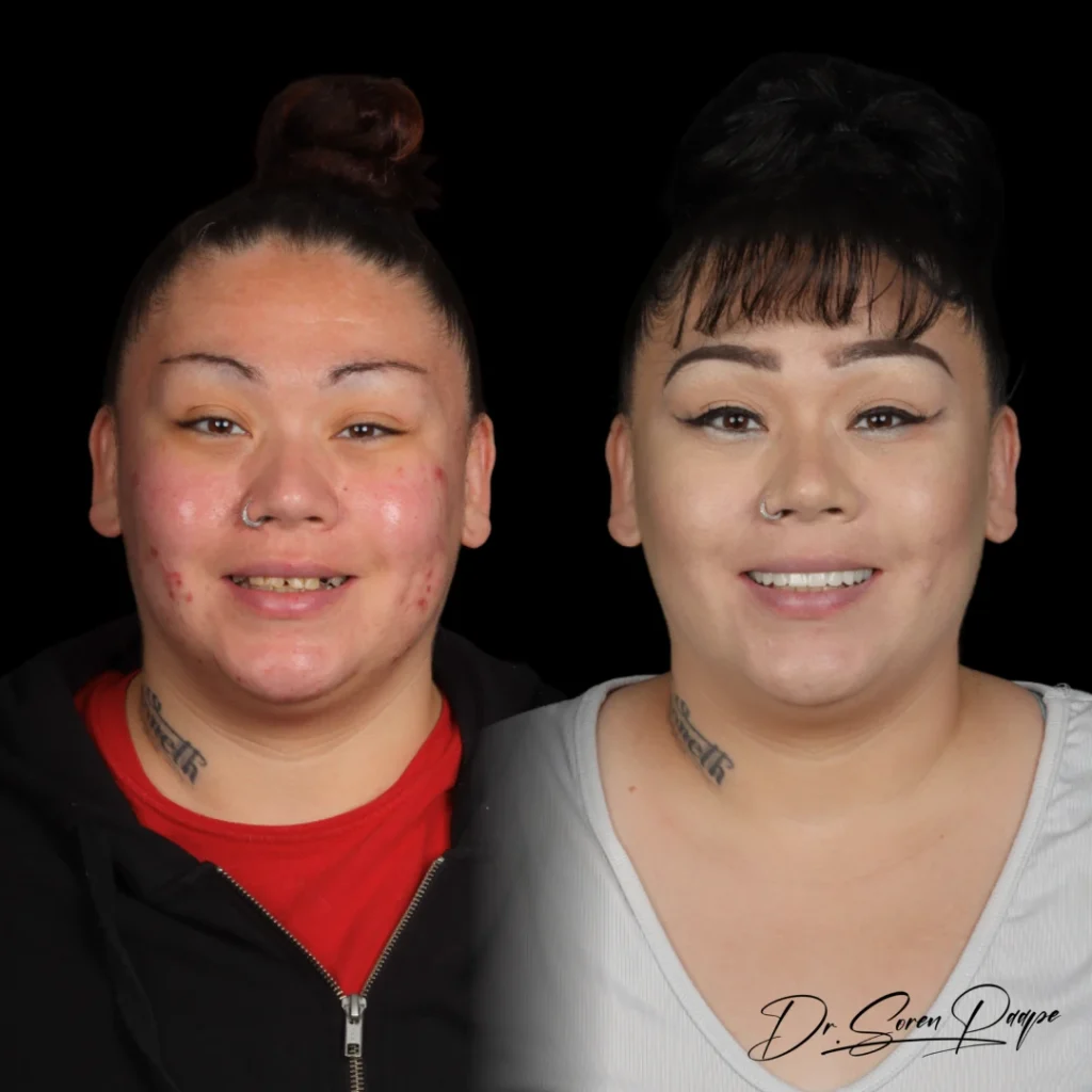 Before and after full mouth dental implants in Denver, CO by Dr. Soren Paape at Smile Now Denver Dentures and Implants
