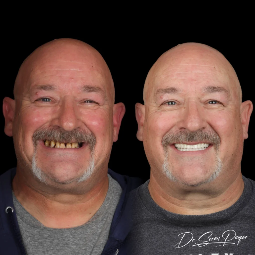 Before and after full mouth dental implants in Denver, CO by Dr. Soren Paape at Smile Now Denver Dentures and Implants