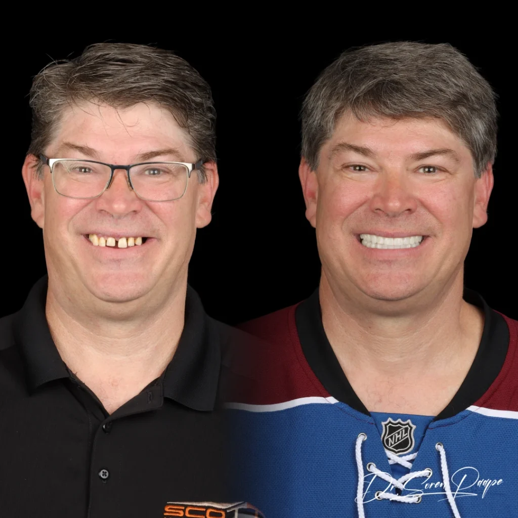 Before and after full mouth dental implants in Denver, CO by Dr. Soren Paape at Smile Now Denver Dentures and Implants