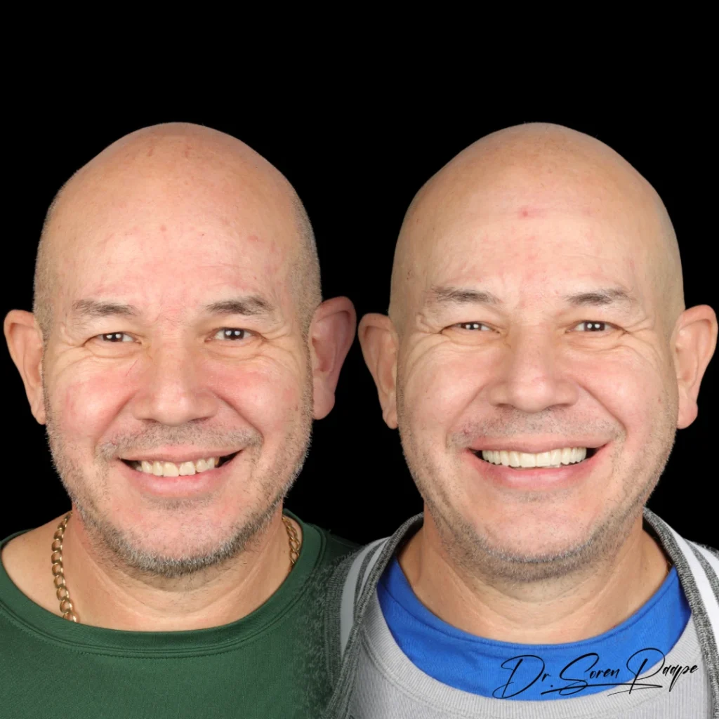 Before and after full mouth dental implants in Denver, CO by Dr. Soren Paape at Smile Now Denver Dentures and Implants