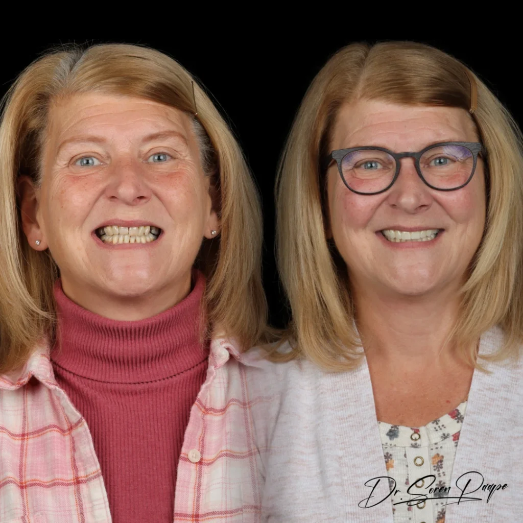 Before and after full mouth dental implants in Denver, CO by Dr. Soren Paape at Smile Now Denver Dentures and Implants