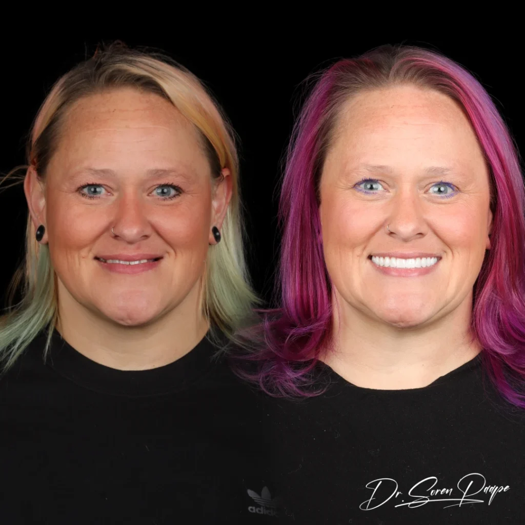 Before and after full mouth dental implants in Denver, CO by Dr. Soren Paape at Smile Now Denver Dentures and Implants