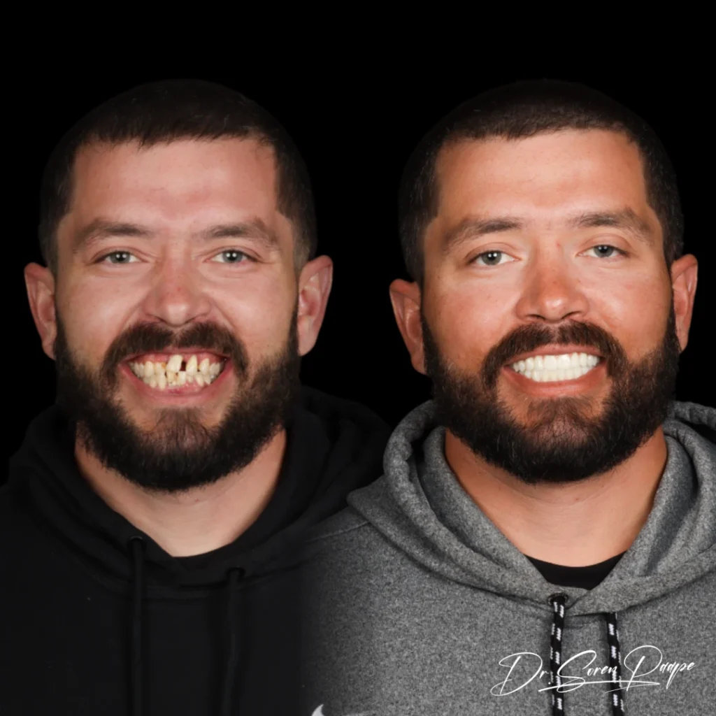 Before and after full mouth dental implants in Denver, CO by Dr. Soren Paape at Smile Now Denver Dentures and Implants