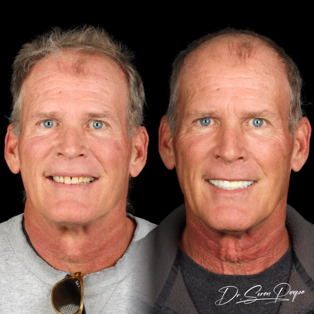 Before and after full mouth dental implants in Denver, CO by Dr. Soren Paape at Smile Now Denver Dentures and Implants