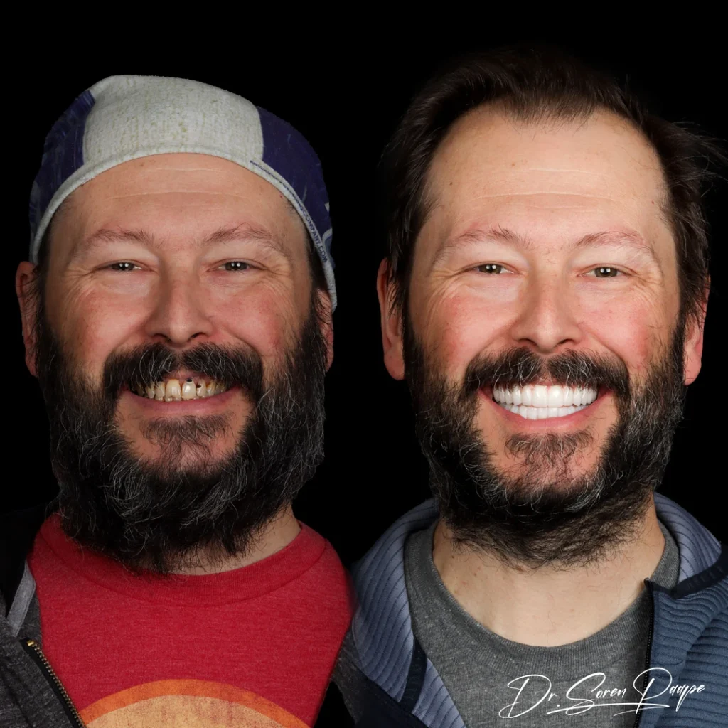 Before and after full mouth dental implants in Denver, CO by Dr. Soren Paape at Smile Now Denver Dentures and Implants