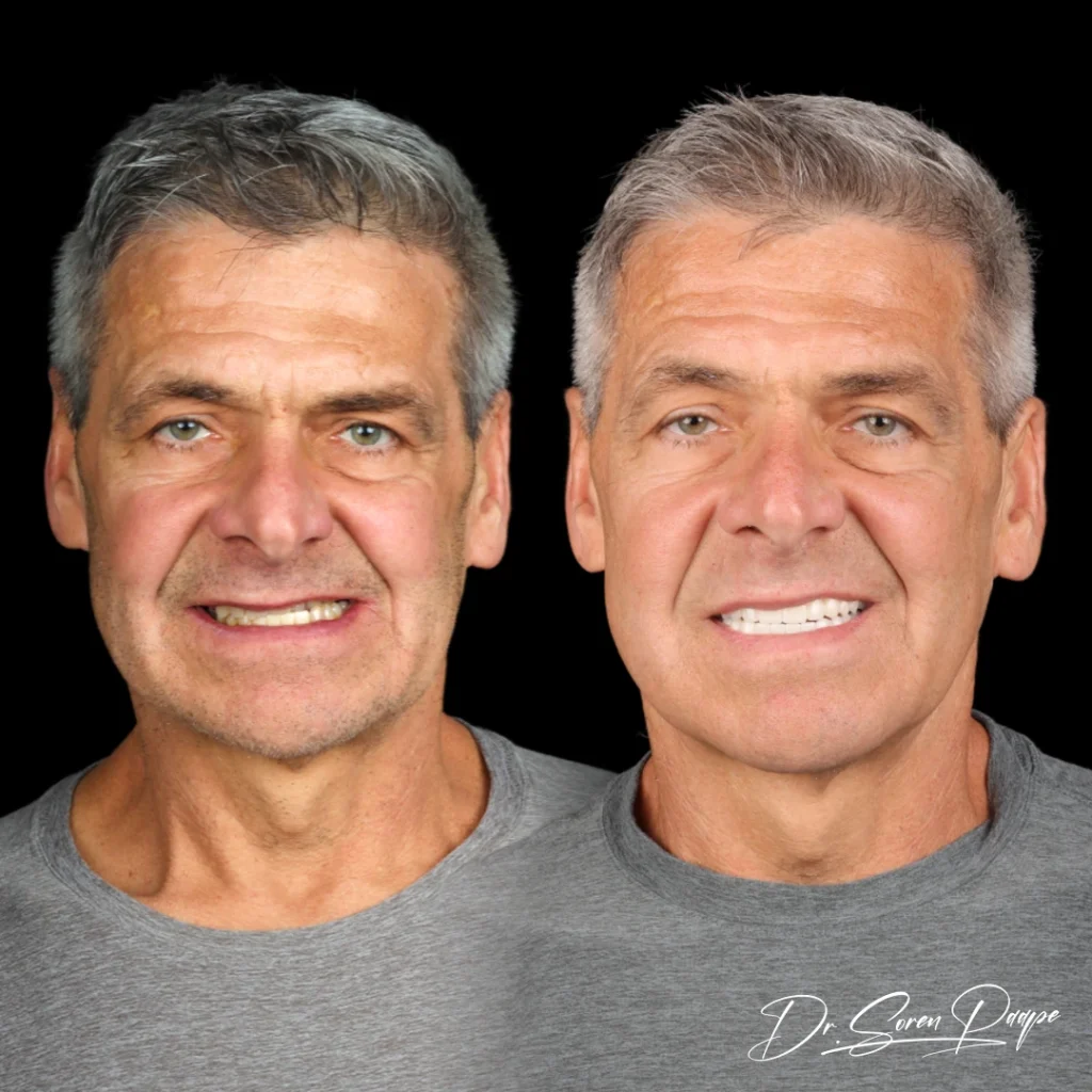 Before and after full mouth dental implants in Denver, CO by Dr. Soren Paape at Smile Now Denver Dentures and Implants