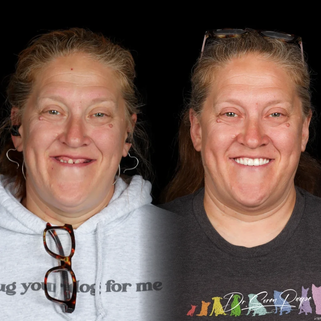 Kerry before and after full mouth dental implants in Denver, CO by Dr. Soren Paape at Smile Now Denver Dentures and Implants