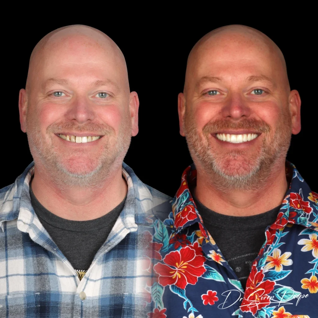 Aaron before and after full mouth dental implants in Denver, CO by Dr. Soren Paape at Smile Now Denver Dentures and Implants