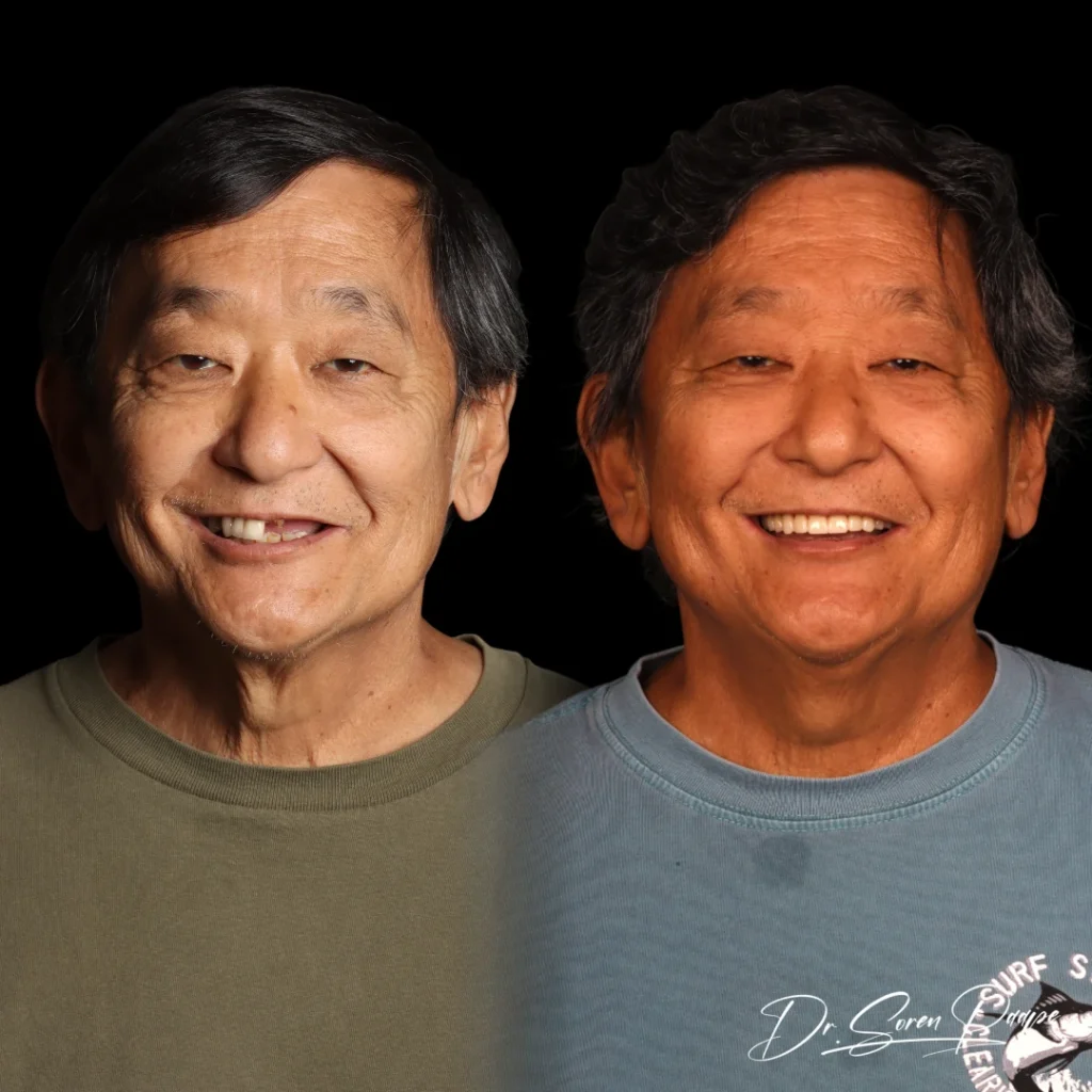 Edward before and after full mouth dental implants in Denver, CO by Dr. Soren Paape at Smile Now Denver Dentures and Implants