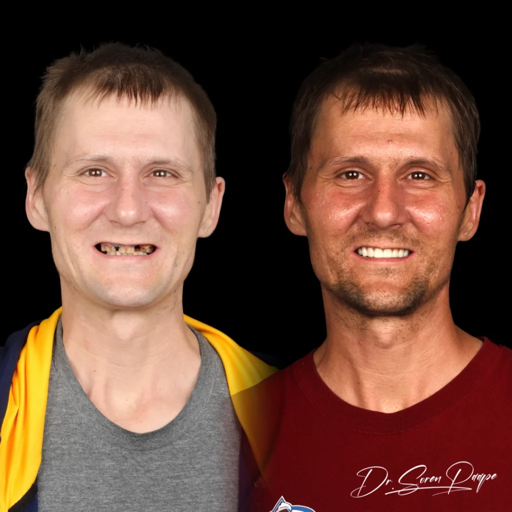 Garrett before and after full mouth dental implants in Denver, CO by Dr. Soren Paape at Smile Now Denver Dentures and Implants