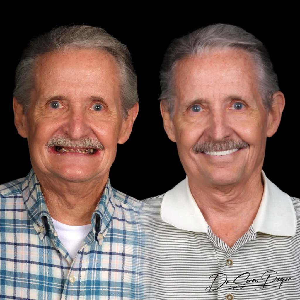 Mark before and after full mouth dental implants in Denver, CO by Dr. Soren Paape at Smile Now Denver Dentures and Implants