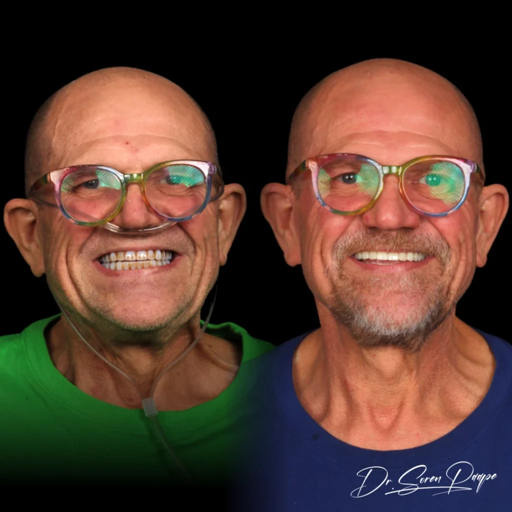 Shawn before and after full mouth dental implants in Denver, CO by Dr. Soren Paape at Smile Now Denver Dentures and Implants