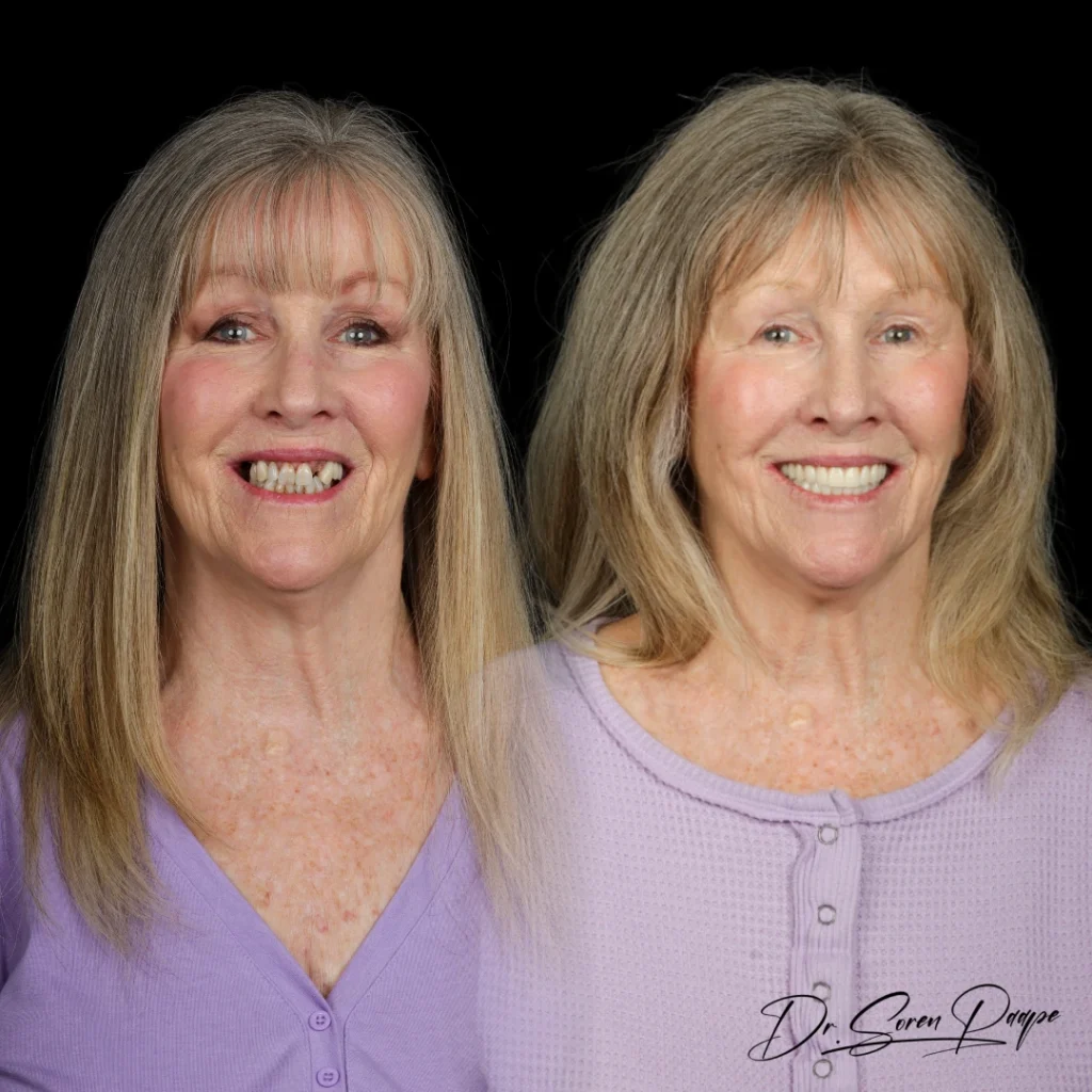 Before and after full mouth dental implants in Denver, CO by Dr. Soren Paape at Smile Now Denver Dentures and Implants