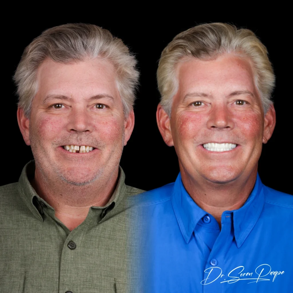 Patient before and after full mouth dental implants in Denver, CO by Dr. Soren Paape at Smile Now Denver Dentures and Implants