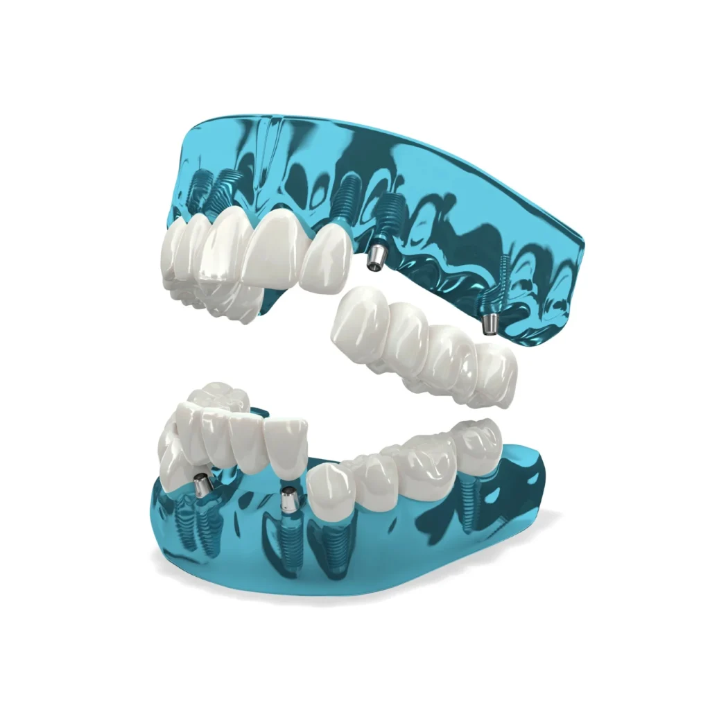 Model showing 3-On-6 dental implants
