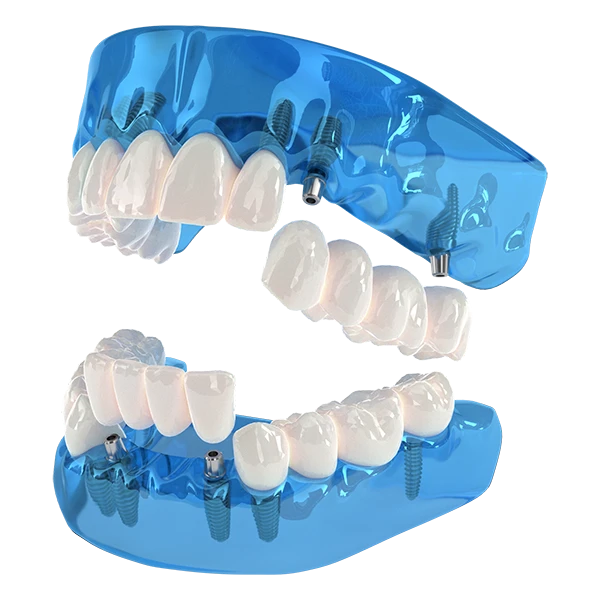 Model showing 3-On-6 dental implants