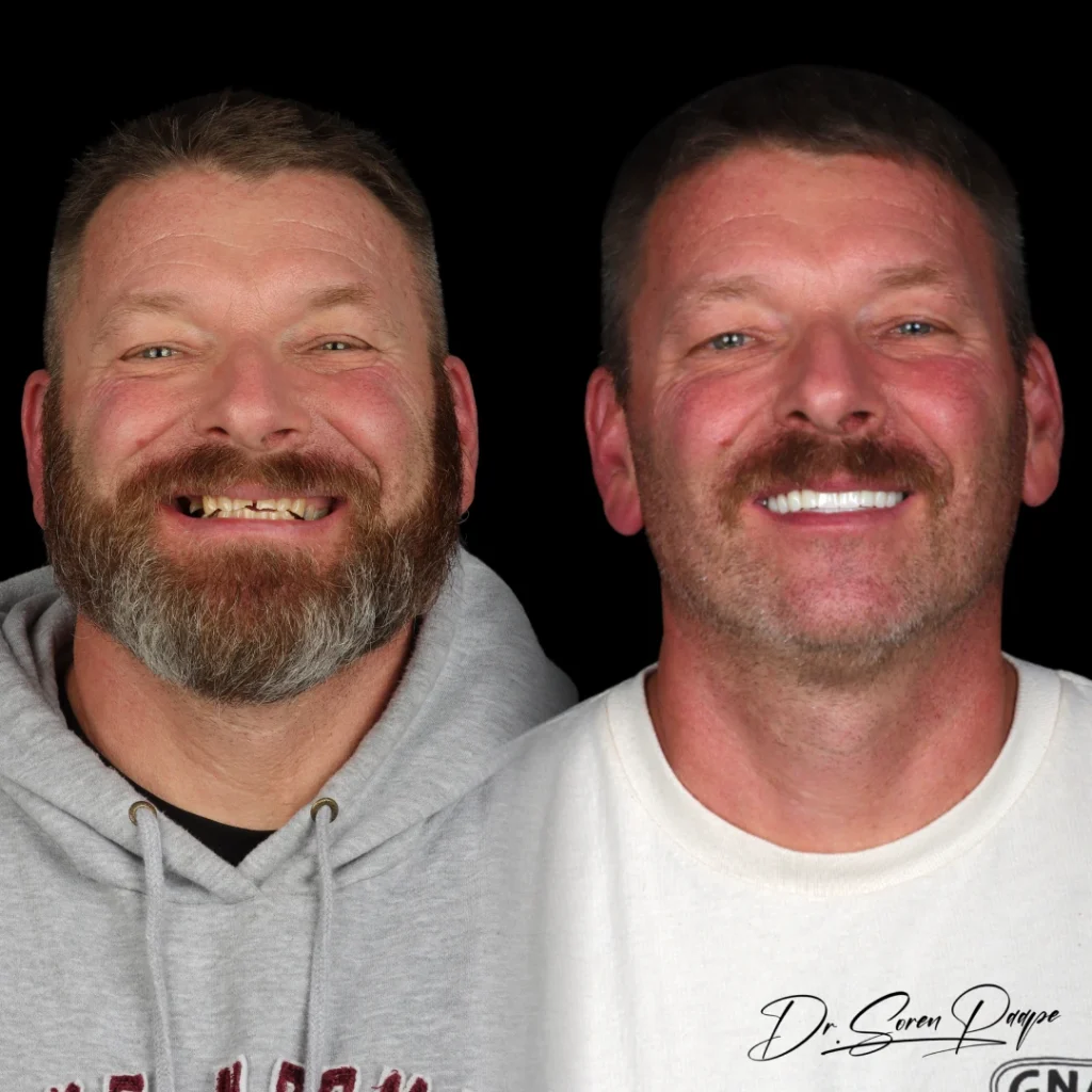 Paul before and after full mouth dental implants in Denver, CO by Dr. Soren Paape at Smile Now Denver Dentures and Implants