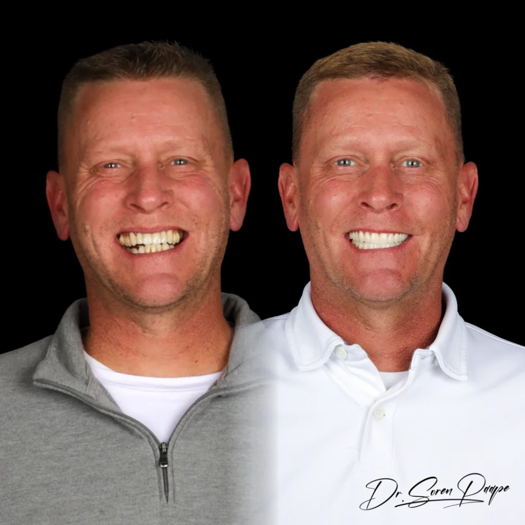 Patient before and after full mouth dental implants in Denver, CO by Dr. Soren Paape at Smile Now Denver Dentures and Implants