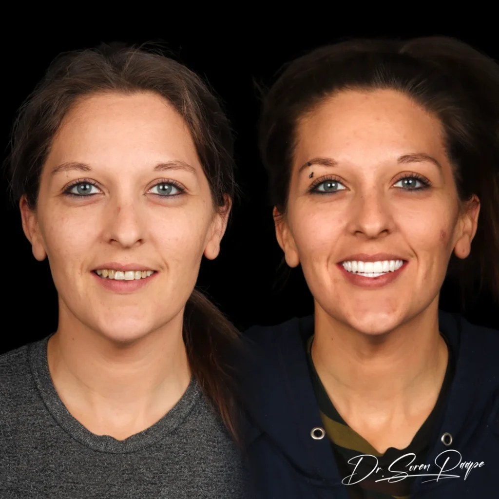 Angela before and after full mouth dental implants in Denver, CO by Dr. Soren Paape at Smile Now Denver Dentures and Implants