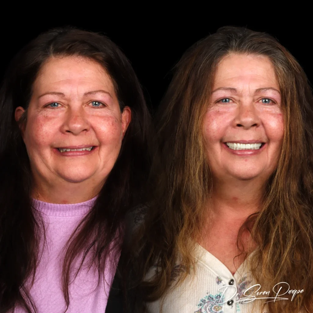 Jolene before and after full mouth dental implants in Denver, CO by Dr. Soren Paape at Smile Now Denver Dentures and Implants