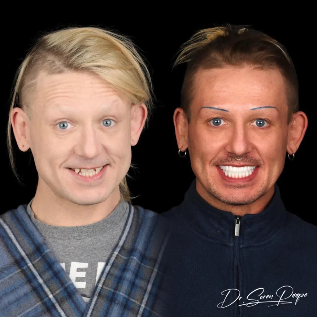 Andy before and after full mouth dental implants in Denver, CO by Dr. Soren Paape at Smile Now Denver Dentures and Implants