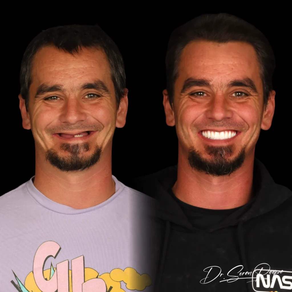 Anthony before and after full mouth dental implants in Denver, CO by Dr. Soren Paape at Smile Now Denver Dentures and Implants