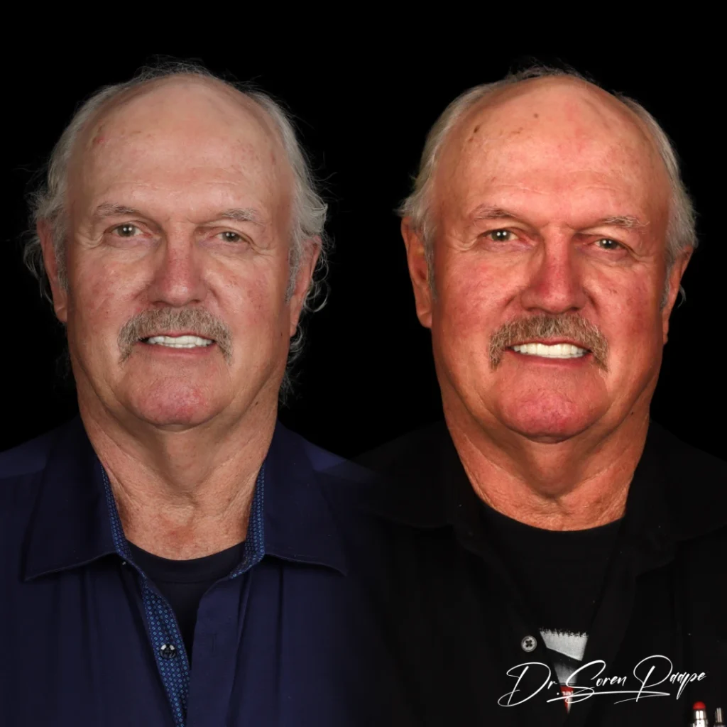 Farrel before and after full mouth dental implants in Denver, CO by Dr. Soren Paape at Smile Now Denver Dentures and Implants