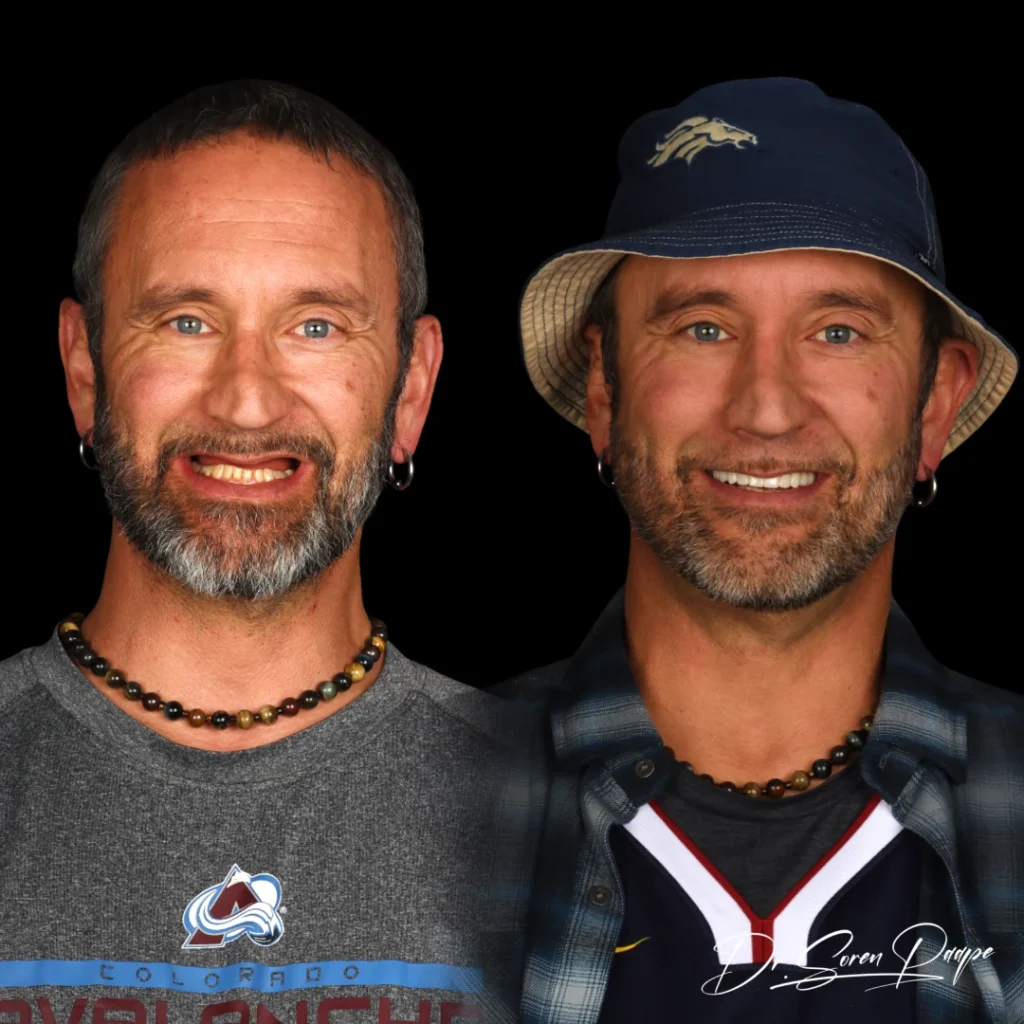 Jared before and after full mouth dental implants in Denver, CO by Dr. Soren Paape at Smile Now Denver Dentures and Implants